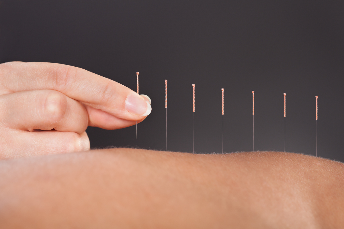 Close-up,Of,A,Person,Getting,An,Acupuncture,Treatment,At,Spa