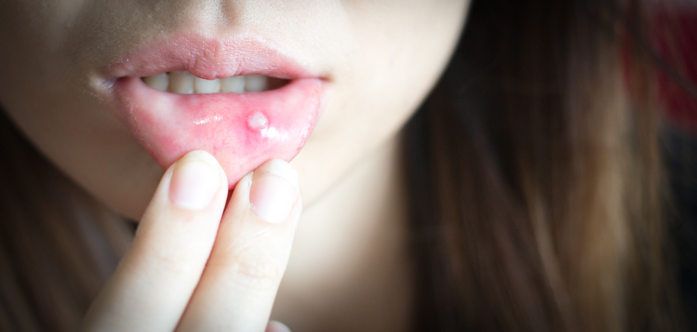 Woman,With,Aphthae,On,Lip.