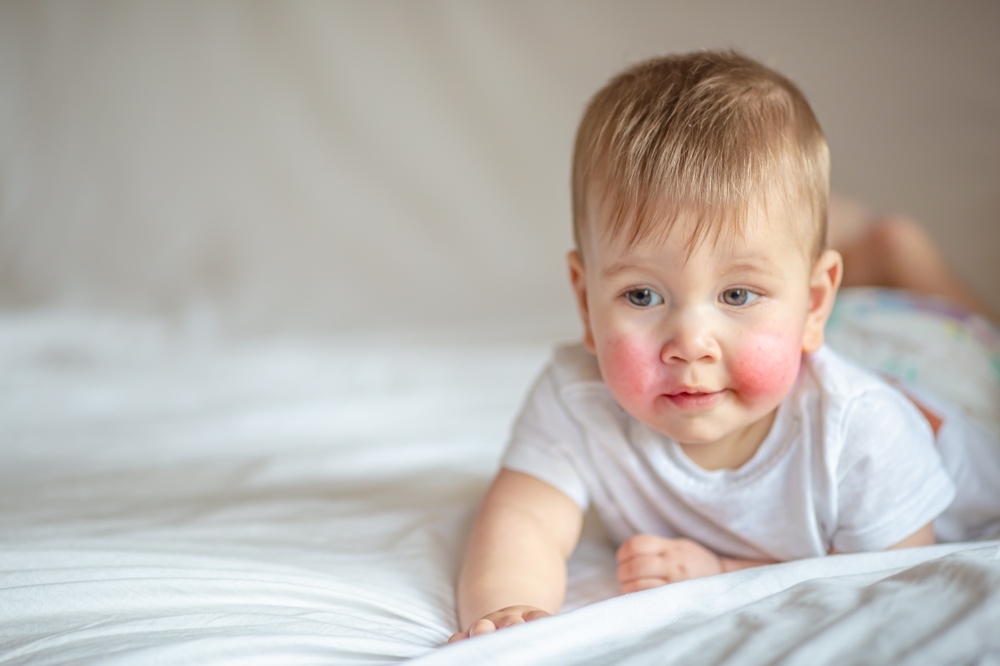 Close-up,View,Of,Baby,Cheek,With,Allergy,Rash,Red,Pimples