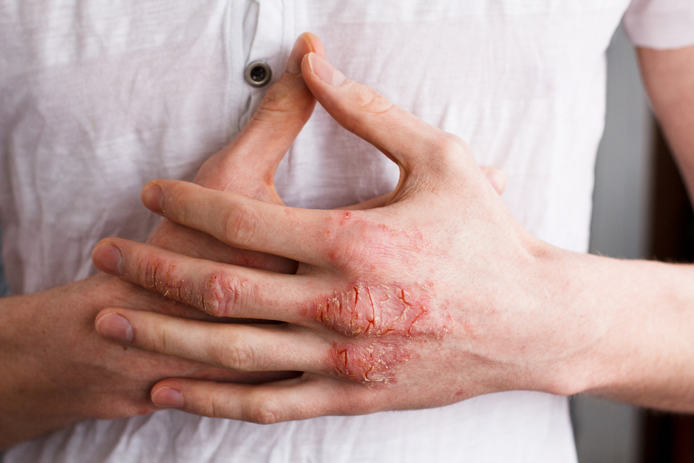 The,Problem,With,Many,People,-,Eczema,On,Hand.,White