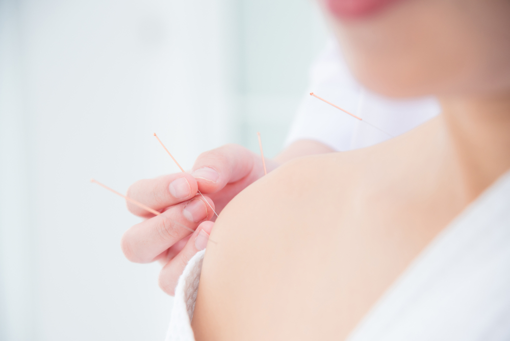 Close,Up,Of,Hands,Doing,Acupuncture,With,At,Patient,Shoulder