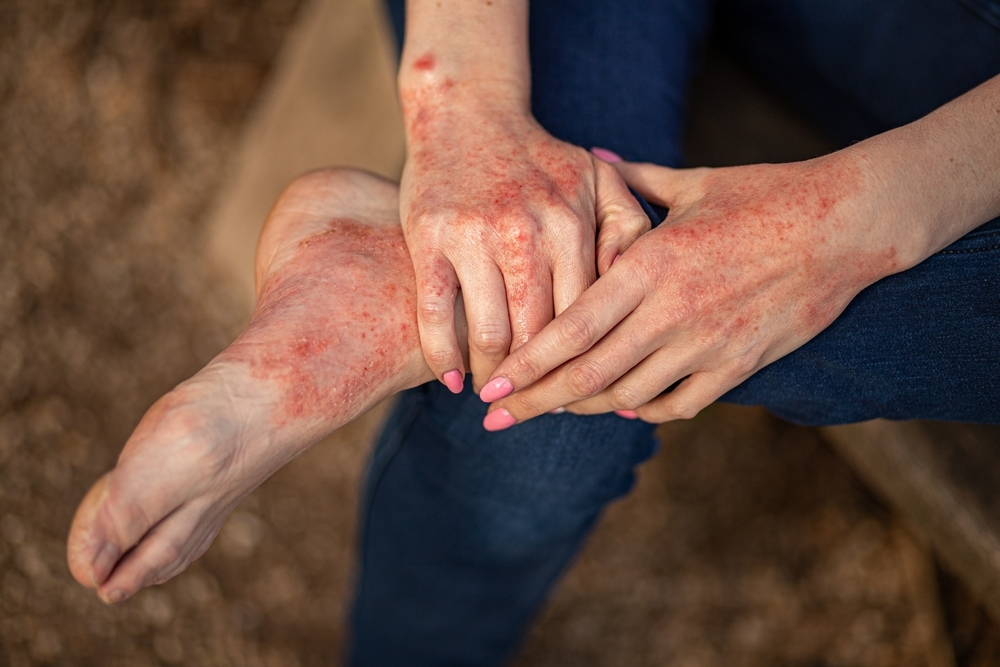 Eczema,Dermatitis,On,Hands,And,Feet.,Red,Spots,On,The