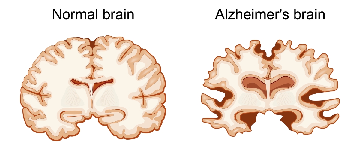 Normal,Brain,And,Alzheimer's,Brain.,Neurodegenerative,Disease.,Vector,Illustration