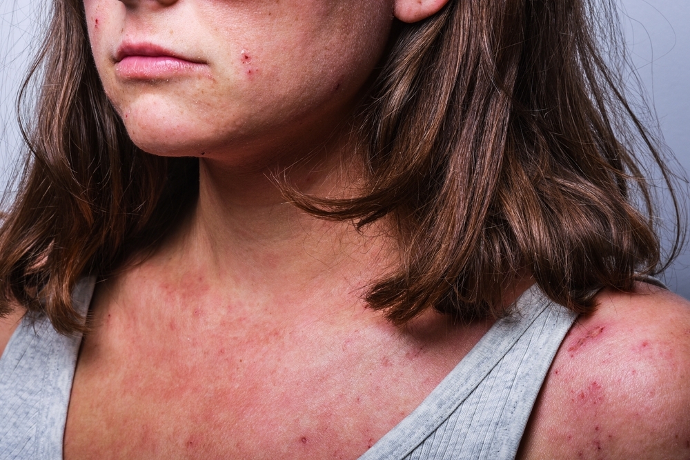 Selective,Focus.,A,Young,Girl,With,Atopic,Dermatitis,In,The