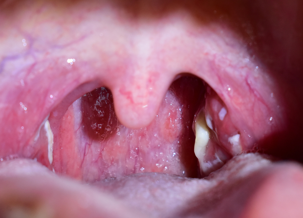 Tonsillitis.,Pus,On,The,Tonsils