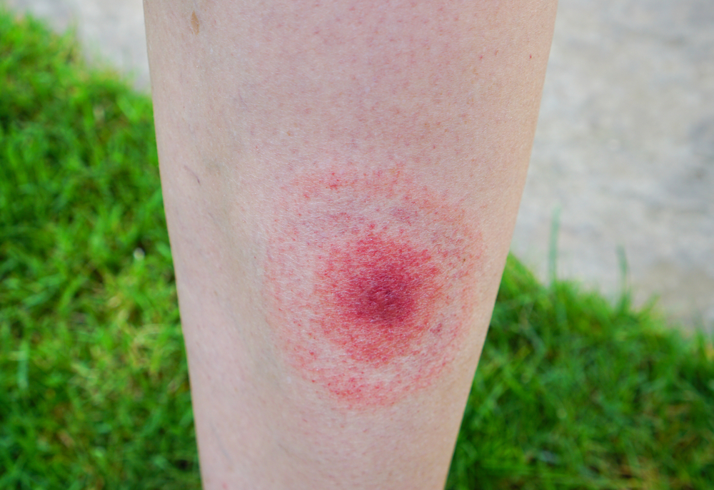 Lyme,Disease,,Borreliosis,Or,Borrelia,,Typical,Lyme,Rash,,Spot.,A