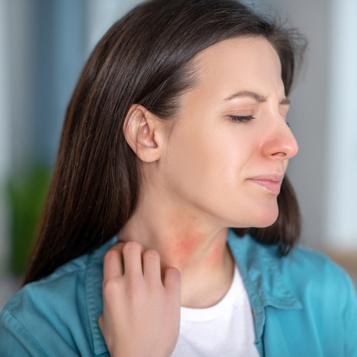 Histaminov intolerance